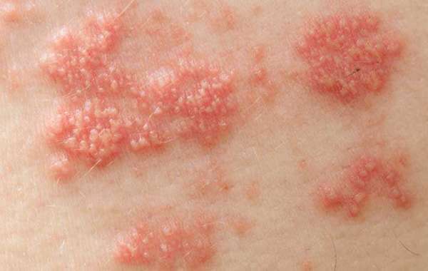 Know the right Shingles Treatment