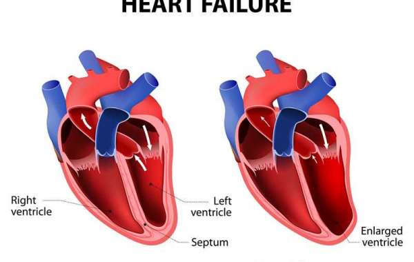 Stages and Symptoms of Congestive Heart Failure