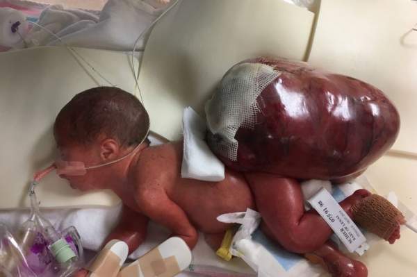 Baby Born With Tumor Bigger Than Her Body Now Thriving After Parents Refuse Abortion  |  LifeNews.com