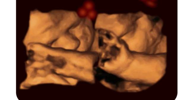 Adverse prenatal diagnosis is not a death sentence for babies