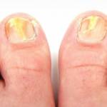 Treat Toenail Fungus Naturally At Home Profile Picture