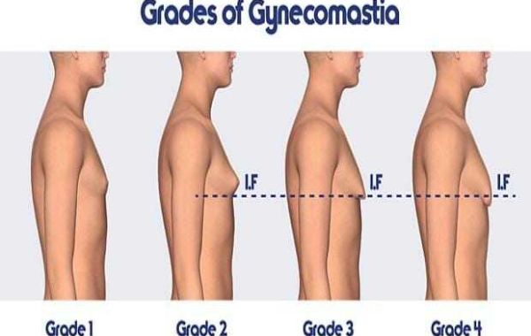 Gynecomastia surgery in jaipur