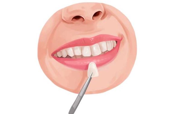 How Does Dental Veneers Work to Restore the Appearance of a Smile?