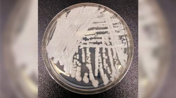 CDC Warns of Dangerous Fungal Infection Spreading Through US at ‘Alarming Rate’ | NTD