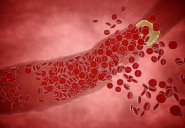 Are Fibrinolytics Key to Preventing Clogged Arteries? - Natural Health Online