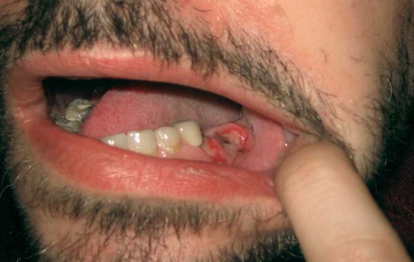 How Long Do Your Teeth Hurt After Veneers?