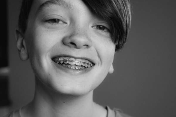 Decoding Dental Braces: Picking the Ideal Option for You | Vipon