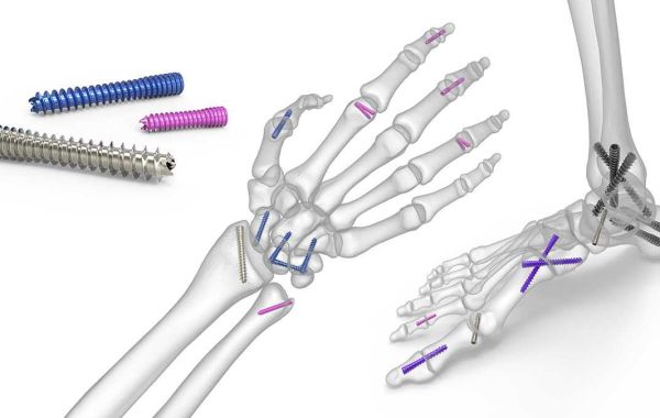 Global Fracture Fixation Products Market Size Growth Driven by Increase in R&D Activities