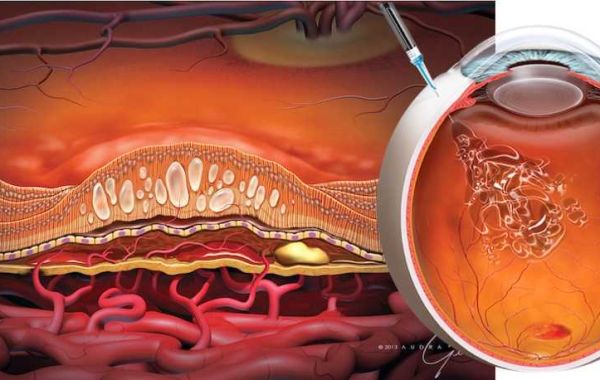 Retinal Drugs Market Size Grows Incredibly; Confirms MRFR Unleashing Market Report upto 2032