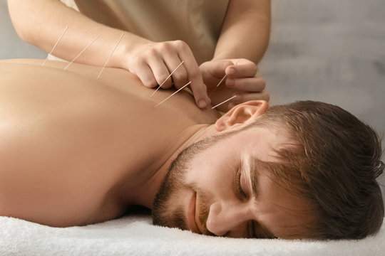 Unlocking the Benefits of Acupuncture at Floreat Acupuncture Perth – Floreat Acupuncture Perth