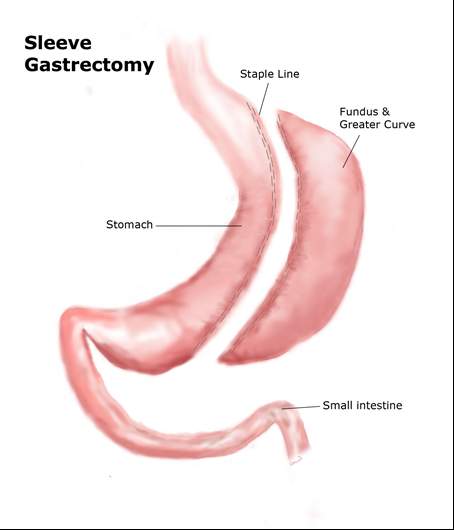 Sleeve Gastrectomy | Obesity Treatment Procedure [2023] | Nexus Surgical