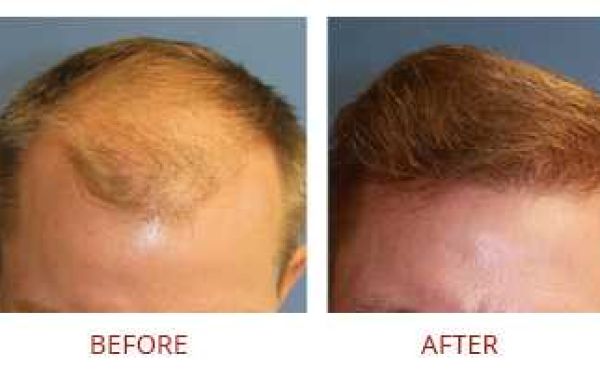 Top Facial Hair Transplant Cost: A Comprehensive Guide