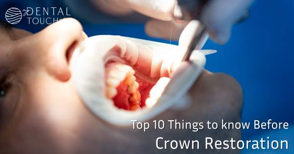 Top 10 Things to Know Before Getting a Dental Crown Done