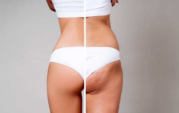 Laser, Light, and More: A Deep Dive into Modern Technologies for Cellulite Reduction