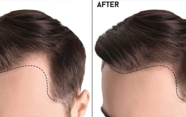 Revitalizing Locks: A Comprehensive Guide to Hair Transplants in Pakistan