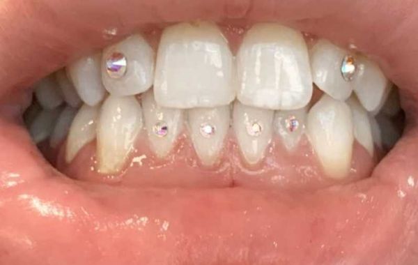 Tooth gems boston Application Experience at Holistic Ink