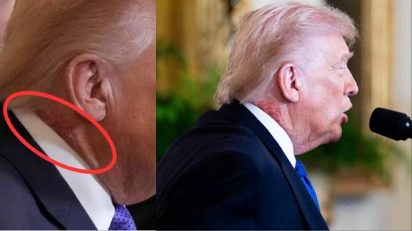 Donald Trump’s Neck Mystery: A Red Rash, a Secret "Cream," and the White House Doctor’s Cryptic Note - celebrity onlines